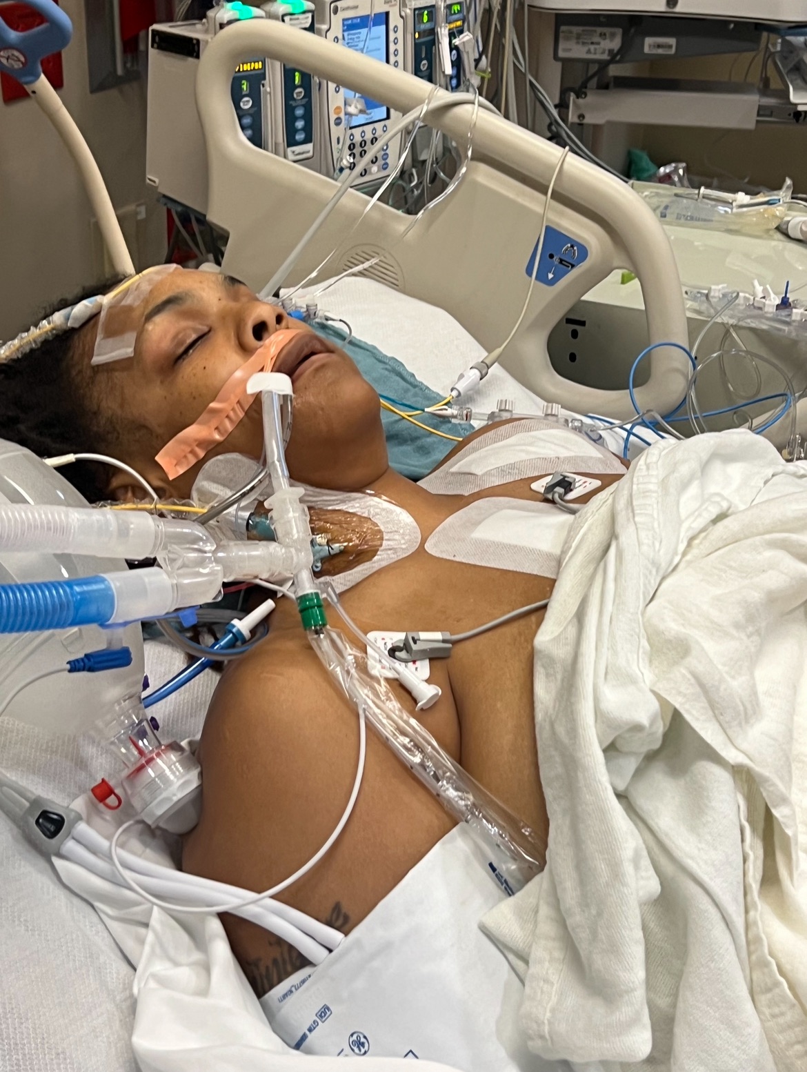 Patient with medical tubes and equipment in a hospital bed, eyes closed, covered with a blanket.