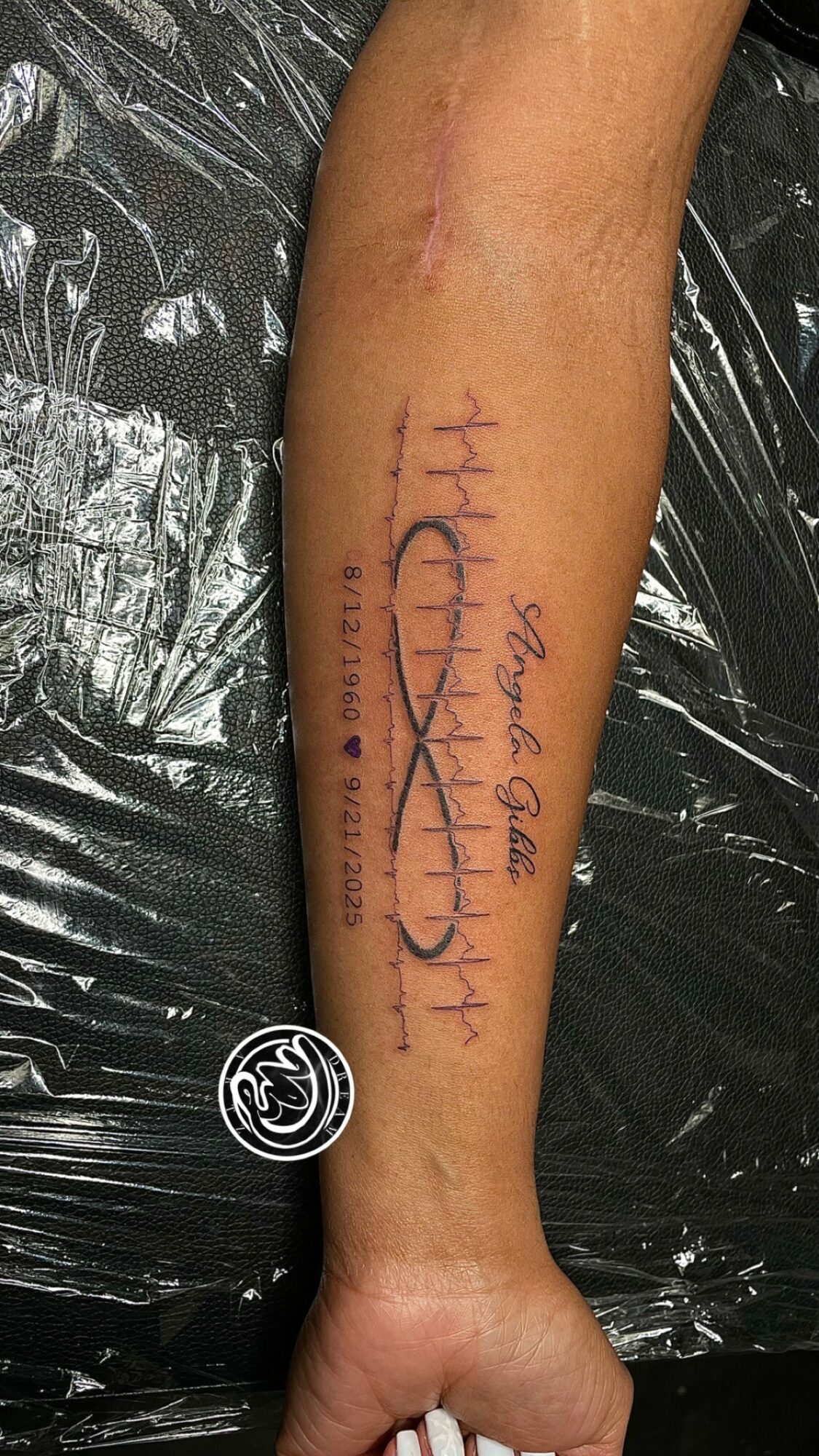 Forearm with fresh surgical scar and handwritten notes in purple ink, resting on a black surface.