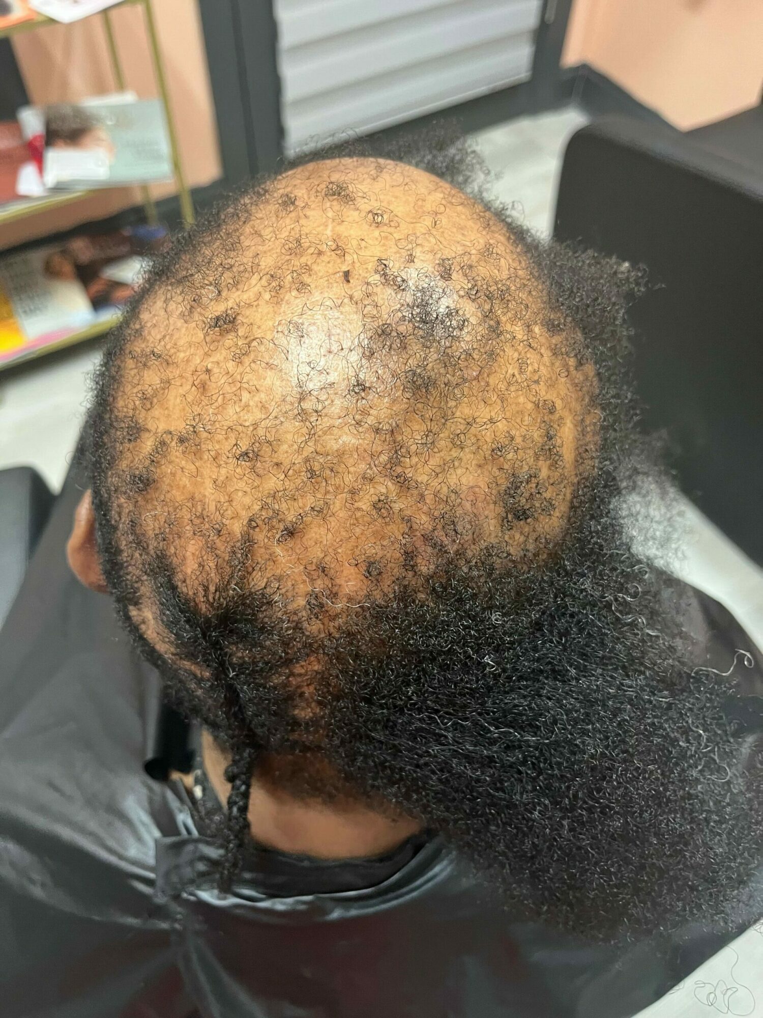 Top view of a person's head with thinning and patchy hair, showing scalp and hair loss areas.